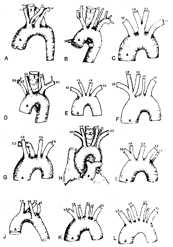 Image of aortic arch variations