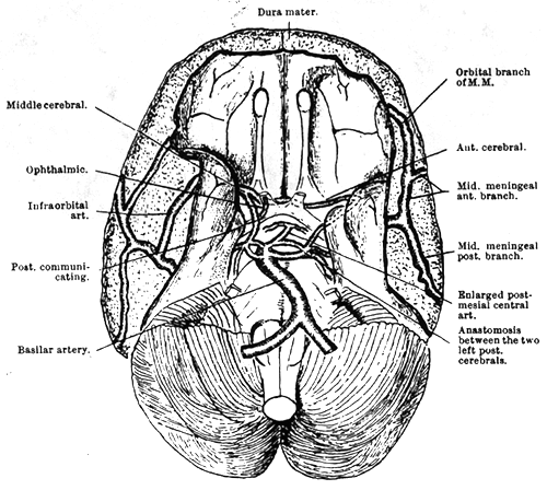 Image of absence of both internal carotid arteries