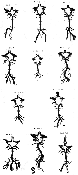 Image of variations in circle of Willis