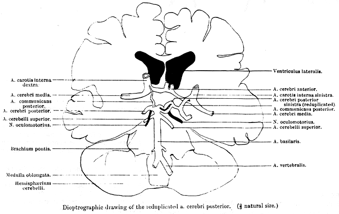 Image of reduplication of posterior cerebral artery