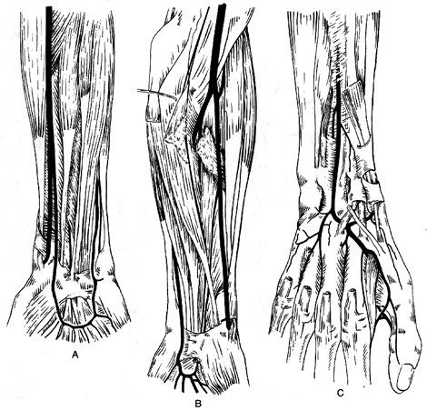 Image of variations in radial artery