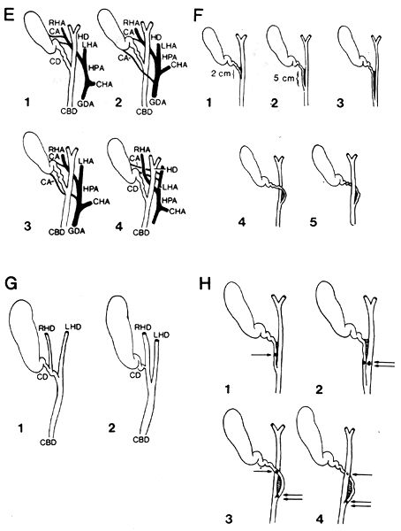 common bile duct cystic duct. hair the common bile duct.