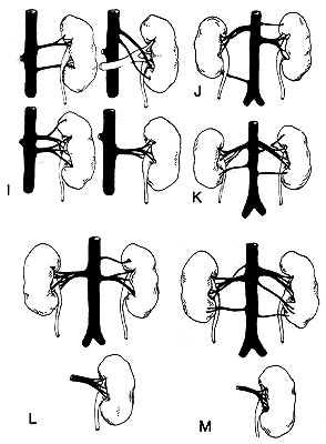 Image of variations in renal vessels