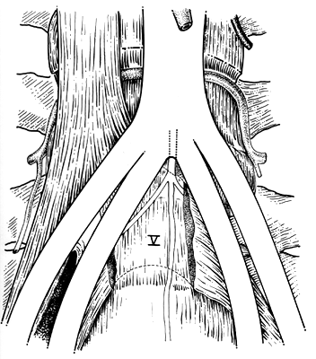 Image of common iliac artery absent, common iliac artery short