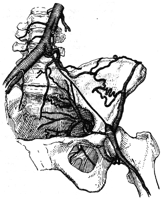 Image of obliteration of left common, external, and internal iliac arteries