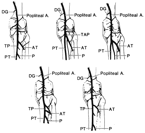 Image of variations in mode of division of popliteal artery