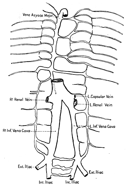 Image of double inferior vena cava
