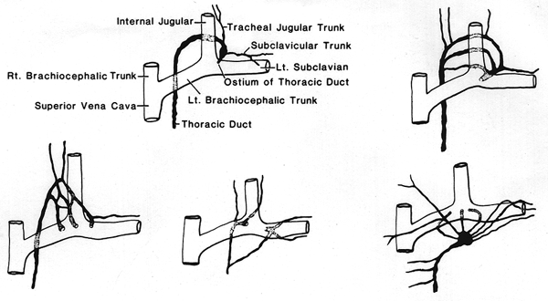 Image of some types of variation in termination of thoracic duct