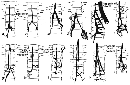 Image of variations in form of thoracic duct
