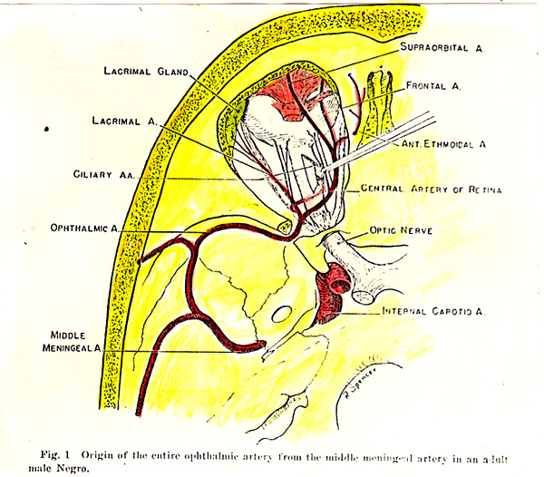 Image of origin of the entire ophthalmic artery from the middle meningeal artery