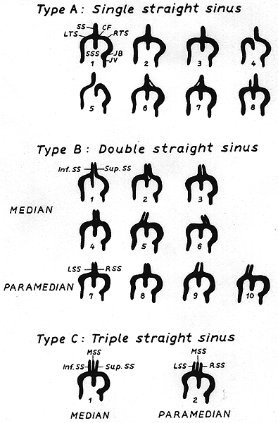 Image of straight sinus