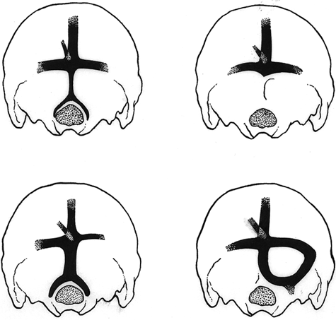 Image of variations in the occipital sinus