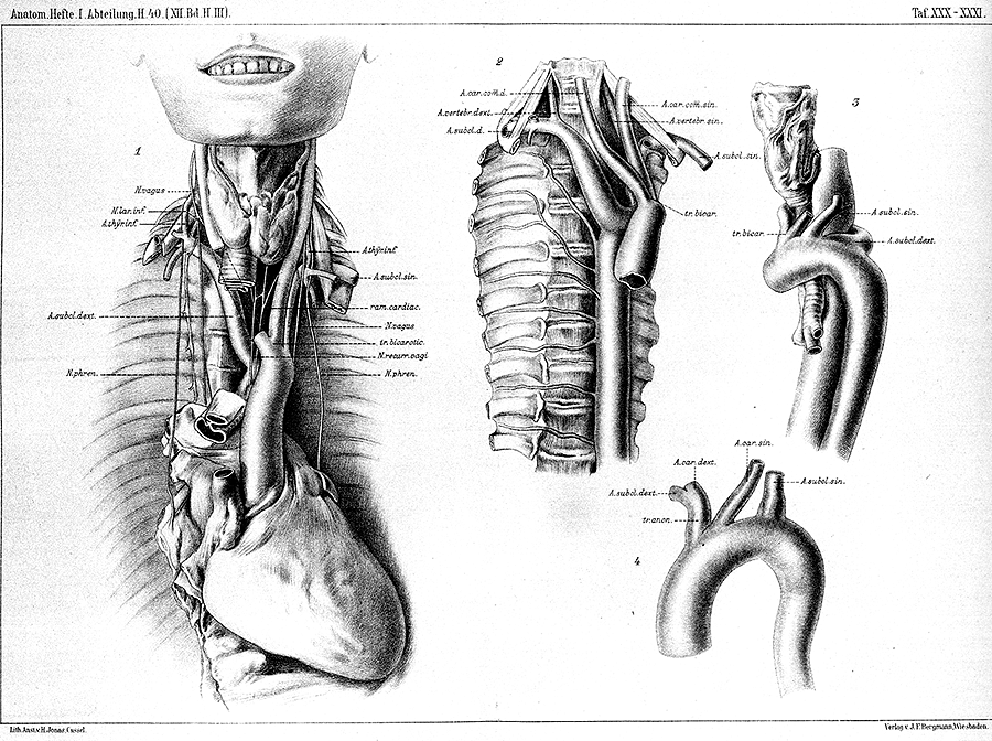 Image of bicarotid trunk, retroesophageal right subclavian artery, right aortic arch, aortic arch ring