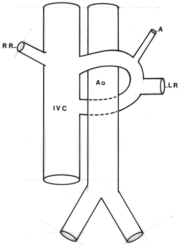 Image of circumaortic left renal vein