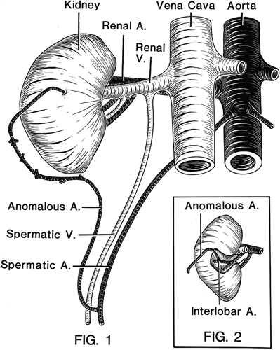 Image of unusual accessory renal arterial vessel