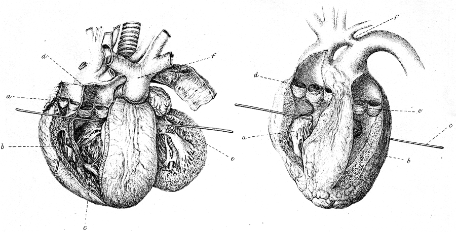 Image of congenital malformation of the heart