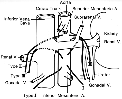 Image of schematic representation of the three types of gonadal arteries of aortic origin on both sides