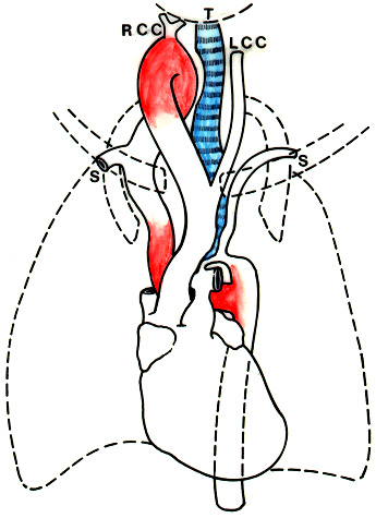 Image of right aortic arch and tretroesophageal aorta