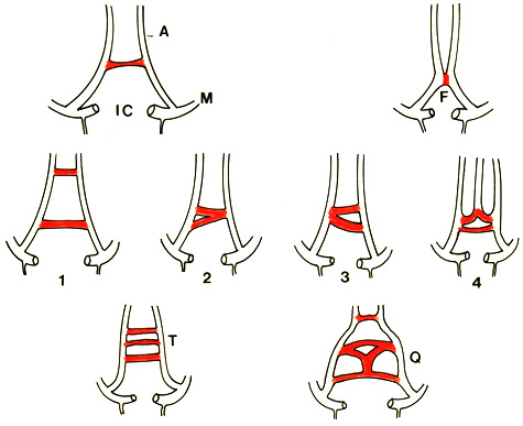 Image of variations in the anterior communicating artery