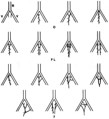 Image of variations of anterior spinal artery