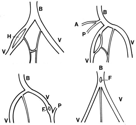 Image of variations of vertebral and basilar arteries