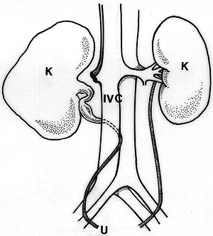 Image of postcaval ureter