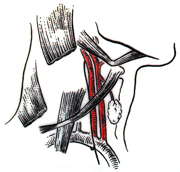 Image of absence of common carotid