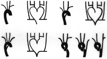 Image of right aortic arch variation with some of their developmental schemas