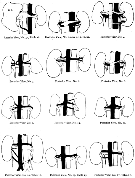 Image of irregular kidney vessels