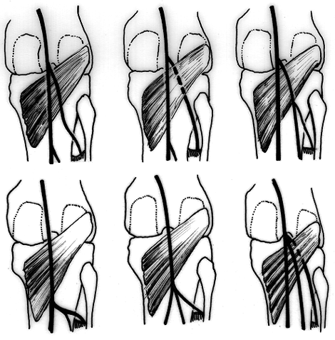 Image of various arrangements of branches of the popliteal artery