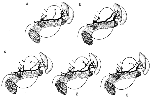 Image of incidence and sex distribution of posterior gastric artery, superior polar artery, and gastrosplenic artery