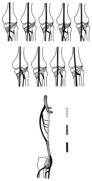 Image of variatn anatomy of popliteal artery and its branches