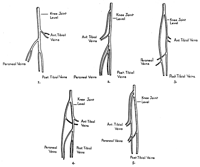 Image of five patterns of formation of popliteal vein