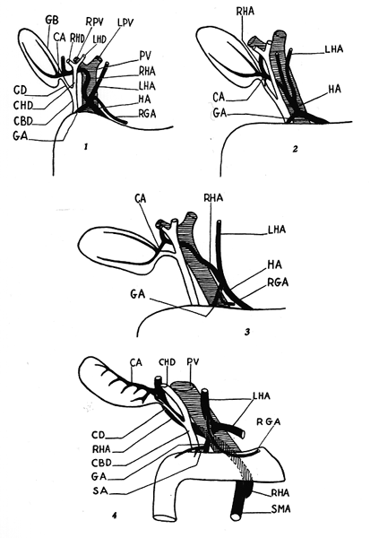 common bile duct cystic duct. CBD common bile duct;