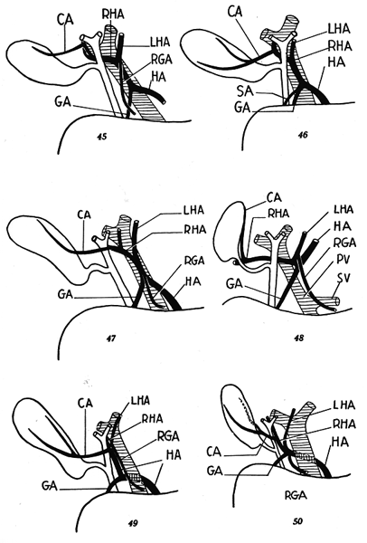 CBD common bile duct; common bile duct cystic duct. CBD common bile duct;