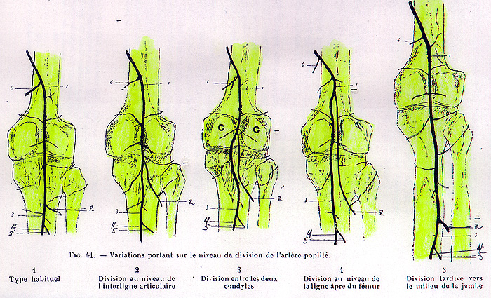Image of several unusual points of division of the popliteal artery