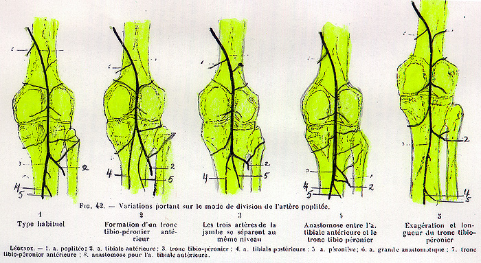 Image of variations in the points of division of the popliteal artery