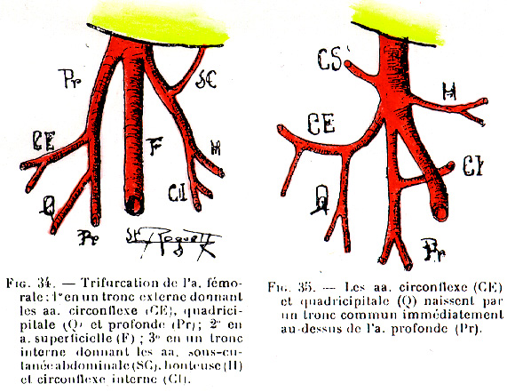 Image of femoral artery branches beyond the inguinal ligament