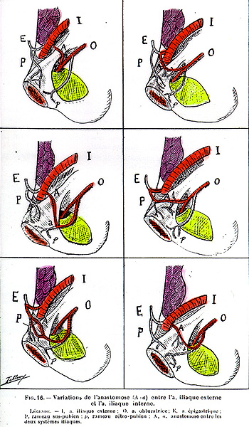 Image of variation of origin of the lateral circumflex artery and muscular branches