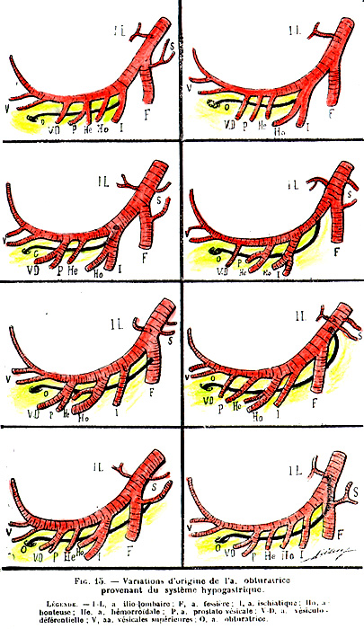 Image of variations in origin of the obturator artery arising from the internal iliac artery