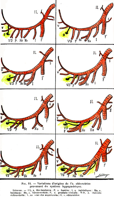 Image of variations in origin of the obturator artery arising from teh internal iliac artery