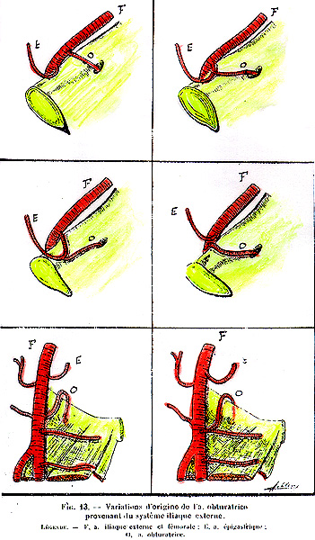 Image of variations in the origin of the obturator artery coming from teh external iliac artery