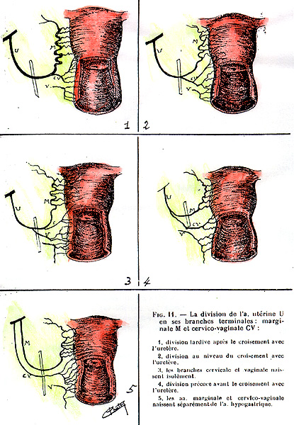 Image of variations between uterine and vaginal arteries
