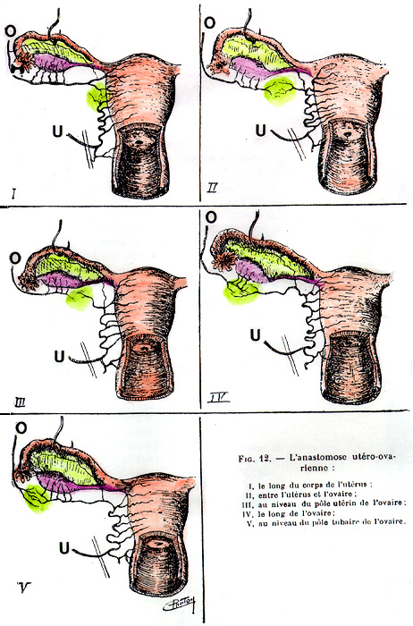 Image of anastomoses between utero