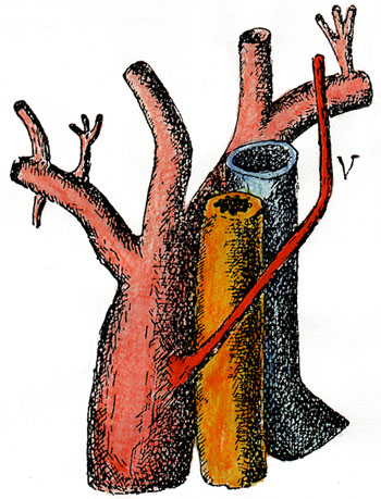 Image of retroesophageal vertebral artery