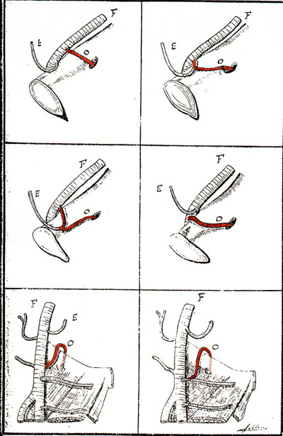 Image of variations in the origin of the obturator artery from the external iliac or femeral arteries