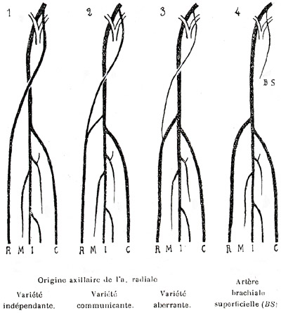 Image of four varieties of axillary artery origin of the radial artery