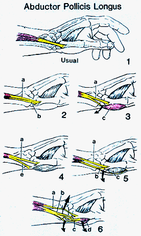 Image of variations of abductor pollicis longus tendons of insertion