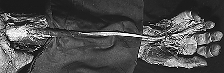 Image of palmaris longus subsituting for the ring finger slip of flexor digitorum superficialis