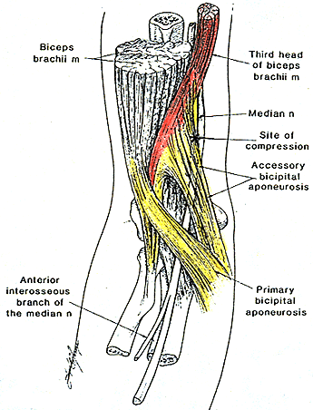 Image of a third head of biceps brachii with accessory bicepital aponeurosis